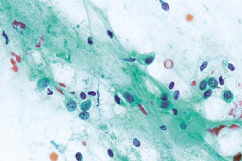 生物显微镜MHL3000明场观察效果 - 病理学标本1